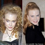 Nicole Kidman Used Botox. Now She’s Over