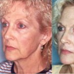Co2 laser resurfacing anti wrinkles treatment