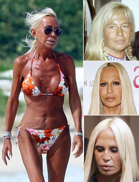 Donatella Versace before after surgery
