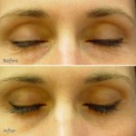 Lumigan effects on eyelashes