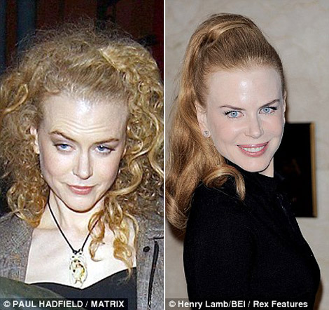 Nicole Kidman Used Botox. Now She’s Over