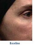 Retinol anti wrinkles treatement