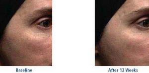 Retinol anti wrinkles treatement